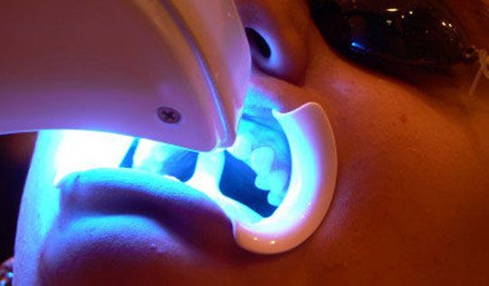 wybielanie-zebow-u-dentysty
